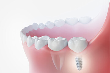 Dental implantation, teeth with implant screw, 3d illustration.
