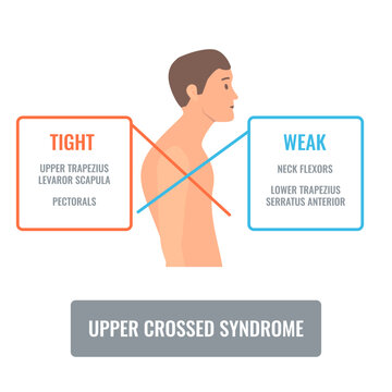 Upper crossed syndrome medical diagram. Crooked man with muscle strength imbalance. Weak and overactive muscles therapy. Incorrect spine curvature caused by bad posture. Vector illustration.