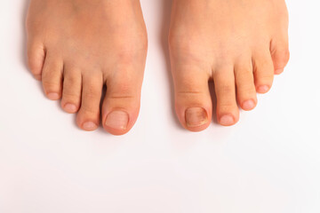 Top view of a feet and one toenail with fungus on it on white background. Nail affected with fungal...