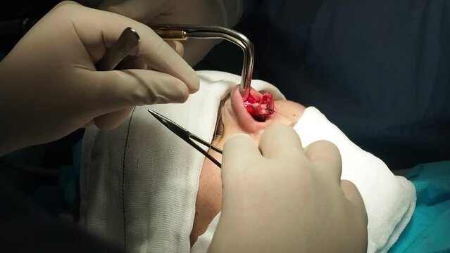 Crop surgeons stitching nose of patient