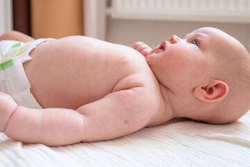 A mark on the baby's arm from BCG vaccination