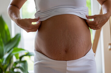 Pregnant belly with stretch marks
