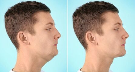 Double chin problem. Collage with photos of man before and after plastic surgery procedure on light...