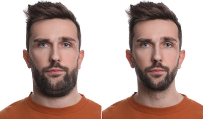 Double chin problem. Collage with photos of man before and after plastic surgery procedure on white...