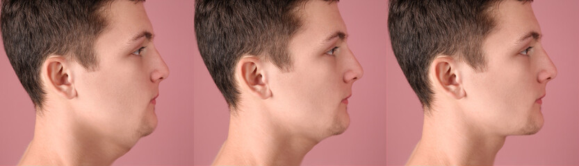 Obraz premium Double chin problem. Collage with photos of man before and after plastic surgery procedure on pink background, banner design