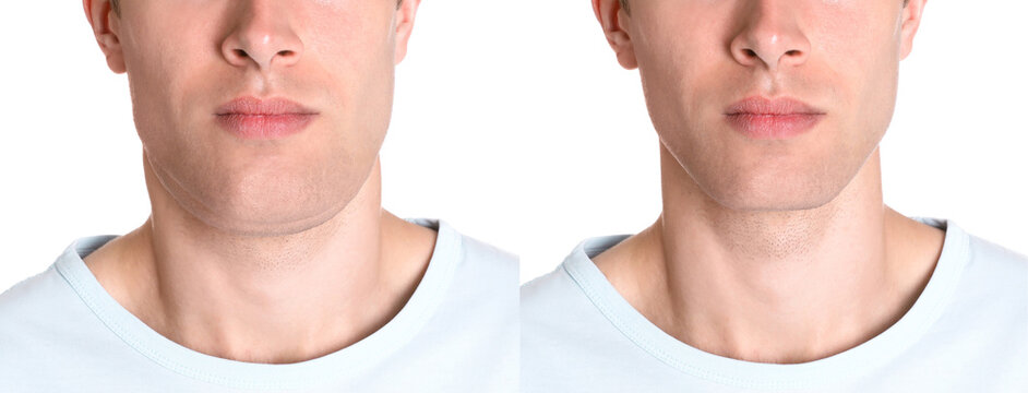 Double chin problem. Collage with photos of man before and after plastic surgery procedure on white background, closeup. Banner design
