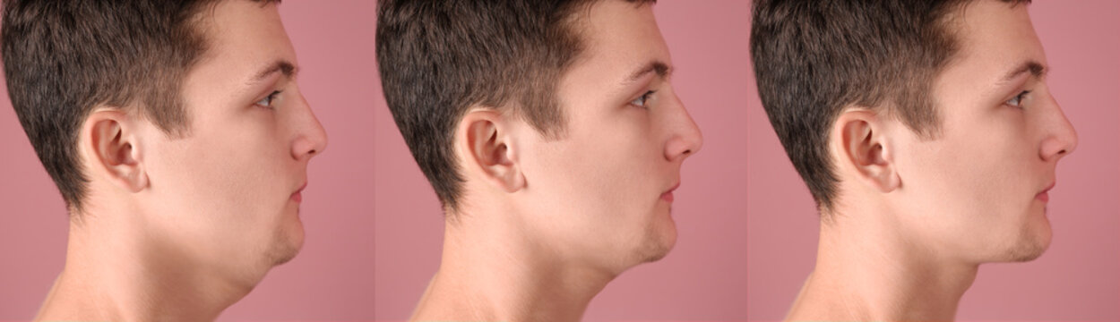 Double chin problem. Collage with photos of man before and after plastic surgery procedure on pink background, banner design