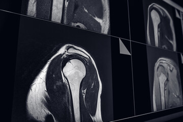 MRI Scan, Magnetic Resonance Images of the shoulder joint - obrazy, fototapety, plakaty