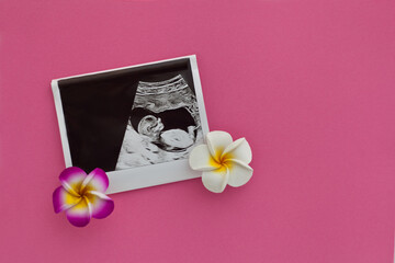 Ultrasound baby photo. Image at pregnancy on pink. Concept of maternity, expectation for baby birth