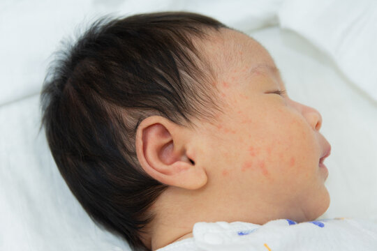 portrait of the face of a newborn baby with red cheeks with small pimples injury to the baby's face in the first few months. atopic dermatitis