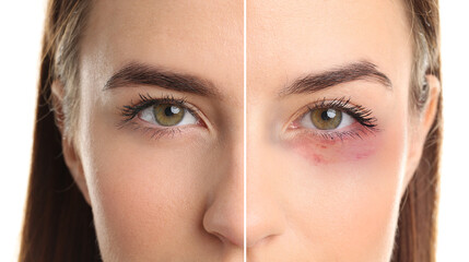 Fototapeta premium Face of young woman with and without bruise under eye on white background, closeup