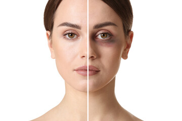 Face of young woman with and without bruise under eye on white background