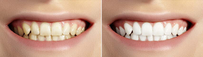 Woman Teeth Before and After Whitening. Perfect Smile with Healthy Teeth. Dental Clinic Patient. Oral Care Dentistry