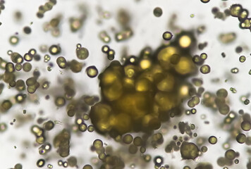 Microscopic image of Urinalysis. Abnormal urine exam. Uric acid crystals. 