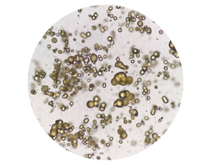 Microscopic image of Urinalysis. Abnormal urine exam. Uric acid crystals. 
