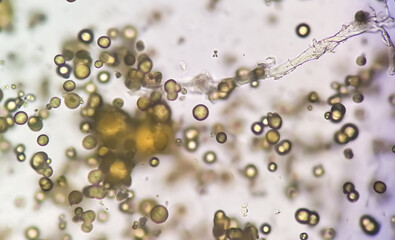 Microscopic image of Urinalysis. Abnormal urine exam. Uric acid crystals. 