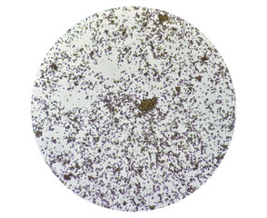Microscopic image of Urinalysis. Abnormal urine exam. Uric acid crystals. 
