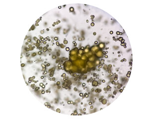 Microscopic image of Urinalysis. Abnormal urine exam. Uric acid crystals. 