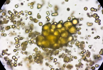 Microscopic image of Urinalysis. Abnormal urine exam. Uric acid crystals. 