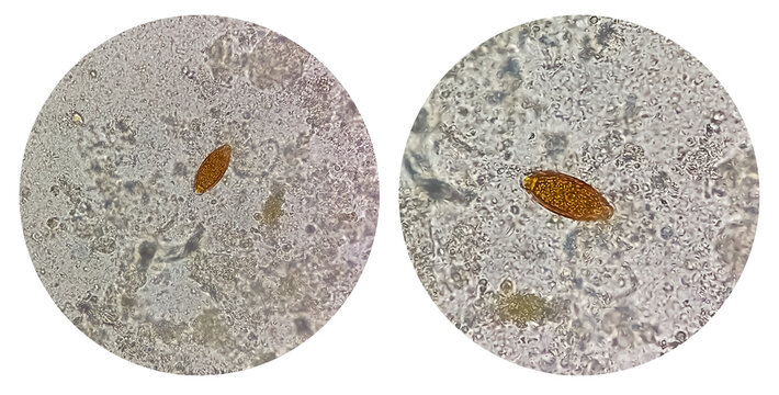 Photo collage of Trichuris trichiura ova (whipworm) in stool, analyze by microscope. Parasite egg.