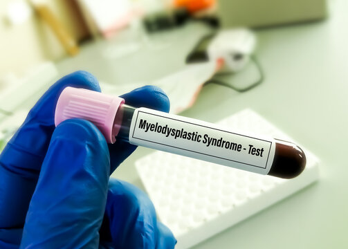 Blood sample for Myelodysplastic Syndrome test. 