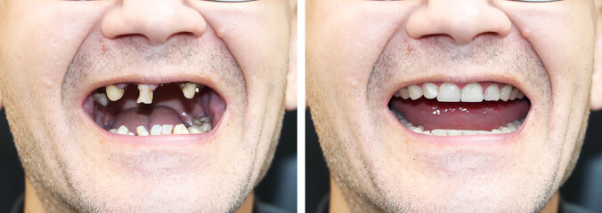 The patient at the orthodontist before and after the installation of dental implants. Tooth loss,...