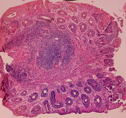Anal canal ulcer biopsy: Chronic nonspecific proctitis, show anal mucosa, dense infiltration of...