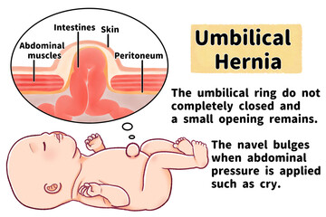 赤ちゃんの臍ヘルニア　英語の図解イラスト