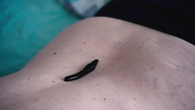 A leech sucks blood on the back of a patient in a hirudotherapy salon 
