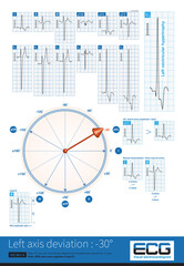 Left ventricular hypertrophy is a common cause of left axis deviation, and on the frontal lead system, the maximum ventricular depolarization potential is facing the upper left quadrant.