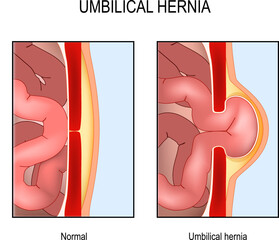 Umbilical hernia. Cross section of abdomen with small intestine