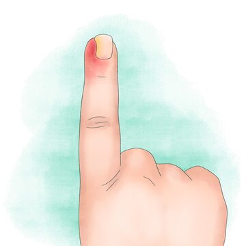 Man&oacute; pintada estilo acuarela con el dedo &iacute;ndice levantado mostrando un u&ntilde;ero enrojecido en el lado izquierdo de la u&ntilde;a amarillenta sobre fondo blanco con mancha de acuarela color turquesa 