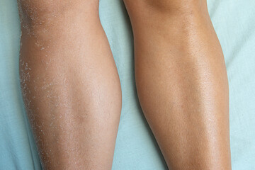 Dry skin and moisturized skin in the legs of a woman