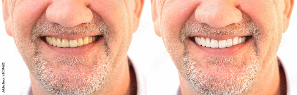 Wall mural closeup smiling caucasian man teeth comparison before and after teeth whitening treatment from yello