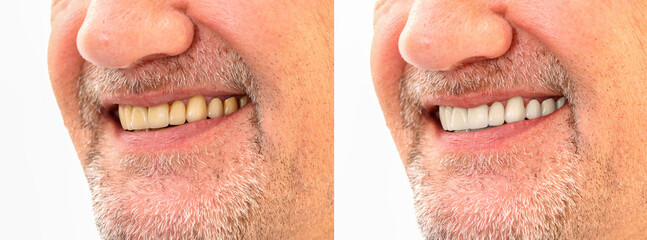Closeup smiling caucasian man Teeth comparison Before and After teeth whitening treatment from yellow to be white teeth. Dental health and oral care in adult Concept. 