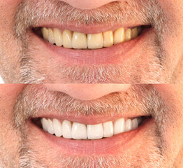 Closeup smiling caucasian man Teeth comparison Before and After teeth whitening treatment from...