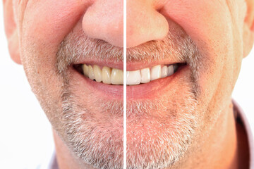 Closeup smiling caucasian man Teeth comparison Before and After teeth whitening treatment from yellow to be white teeth. Dental health and oral care in adult Concept. 