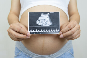 Close up pregnant woman holding ultrasound image. Concept of pregnancy, Asian Young mother waiting...
