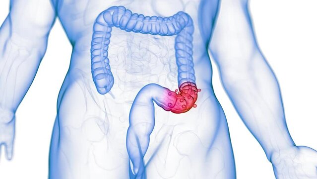 3d rendered medical animation of crohns disease
