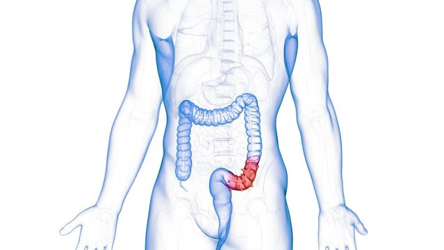 3d rendered medical animation of crohns disease