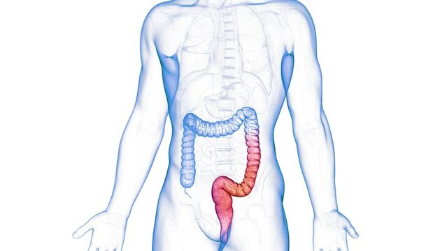 3d rendered medical animation of colitis ulcerosa