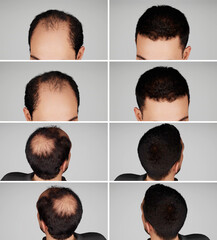 3D Render and 3D illustration Man before after hair loss treatment. Head balding man before after...