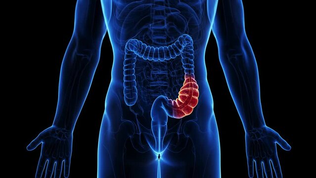 3d rendered medical animation of a constipation