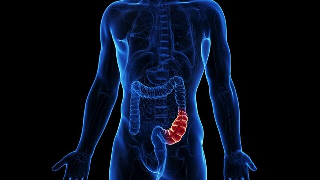 3d rendered medical animation of a constipation