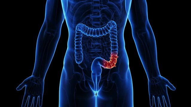 3d rendered medical animation of a man suffering from diverticulitis