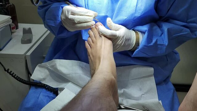 Podiatrist in white gloves clean with cotton a toenail. Concept of podology and chiropody.