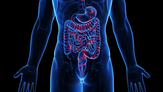 3d rendered medical animation of the colon of a man suffering from crohns disease
