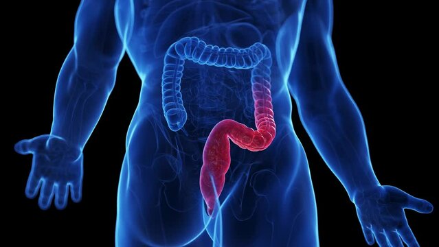 3d rendered medical animation of the colon of a man suffering from colitis ulcerosa