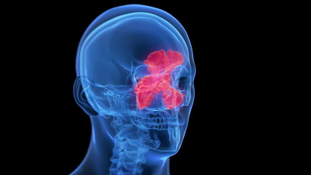 3d rendered medical animation of inflamed sinuses