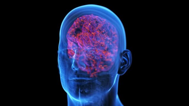 3d rendered medical animation of an infected brain